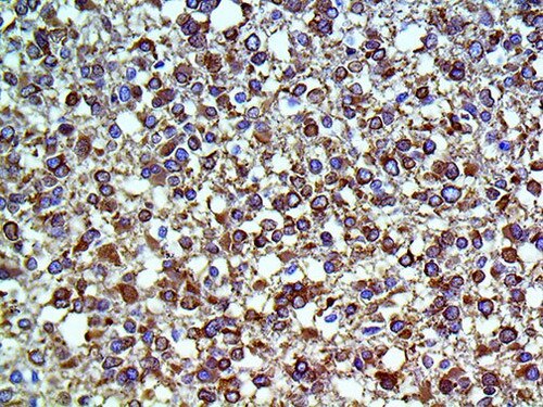 IHC of Tau on a FFPE Astrocytoma Tissue